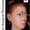 Non-Surgical Rhinoplasty (The PRIME Series) (Original PDF from Publisher)