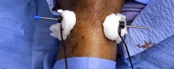 surgical Video Articles JOMI Video Journal Peer Reviewed2 2023