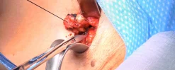 surgical Video Articles JOMI Video Journal Peer Reviewed1 2023
