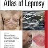 Atlas of Leprosy (Original PDF from Publisher+Videos)